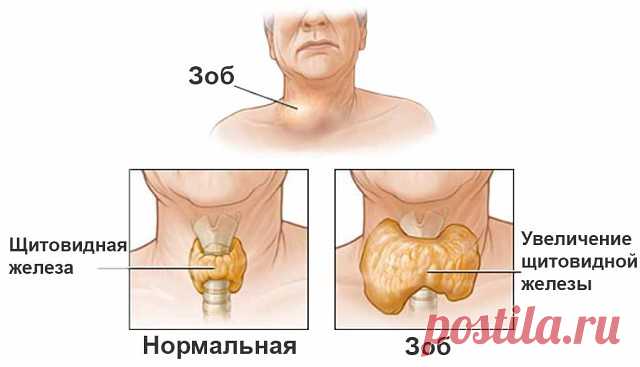 Проще простого: йод, хвойный отвар и лавровый лист. Бабушкины рецепты.

Мне уже 76 лет, много пережито и испытано в жизни, столько болезней перенесла. Вот и хочу поделиться опытом. Как я излечила зоб. Выросла я на реке Ангаре, в воде которой очень мало йода. Наверное, в этом одна из причин того, что зоб - довольно распространенное заболевание среди жителей тех краев. Когда попала в Иркутскую областную клинику на консультацию к эндокринологу, то, увидев больных с нарушением...