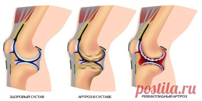 8 РЕЦЕПТОВ ДЛЯ ОЧИЩЕНИЯ СУСТАВОВ! 


№1.Регулярное употребление вареного риса очень хорошо очищает суставы. Рис обладает свойством «вытягивать» соли, которые отложились в суставах. Чем дольше рисовые зёрна замочены в воде, тем эффекти…
