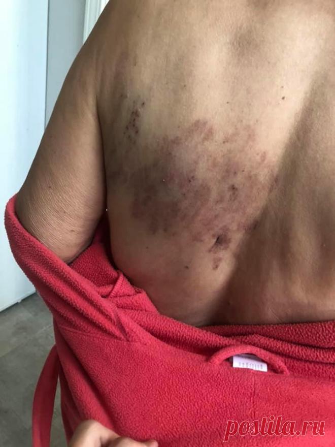 Ой !!! Ребета спасайте!!! Мама подцепила опоясывающий лишай где-то 🙁 Мы живем  в Америке , были два раза у врача ( не дерматолог) приписали лекарство на 10 дней и обезболивающее. Потом это почему-то...