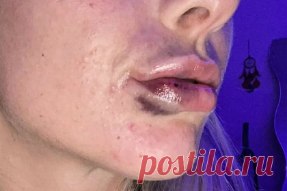 Девушка показала ужасающие результаты использования дешевых филлеров для губ. Жительница Уэльса Натали Овертон осталась с распухшими губами в синяках после того, как решилась на использование дешевых филлеров. По словам 24-летней валлийки, мастера для процедуры она нашла в социальных сетях и согласилась на увеличение губ из-за сравнительно низкой стоимости инъекций — 75 фунтов стерлингов.