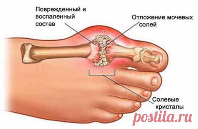 Вкусная профилактика подагры: как предотвратить заболевание суставов и спать спокойно
