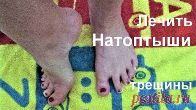 СИЛЬНОЕ СРЕДСТВО от НАТОПТЫШЕЙ реально работает