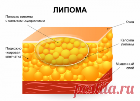 Как вылечить подкожные жировики на теле