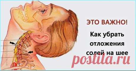 КАК УБРАТЬ ОТЛОЖЕНИЯ СОЛЕЙ НА ШЕЕ

Отложение солей на шее называют остеохондрозом шейного отдела позвоночника. Вследствие того, что шейный отдел позвоночника является весьма важной частью организма, нарушения в этой области приводят к серьезным нарушениям всего организма.

Область шеи является местом сосредоточения сосудов и нервов, питающих ткани шеи, лица, черепа. Кроме того, вследствие защемления нервных окончаний начинаются головные боли, онемение конечностей, слабость...