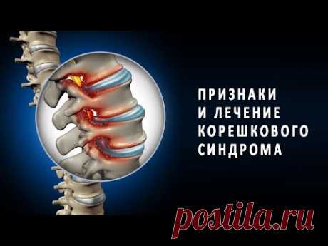 Признаки и лечение корешкового синдрома