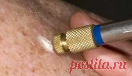 Методы удаления родинок: азотом, лазером, электрокоагуляцией, радионожом