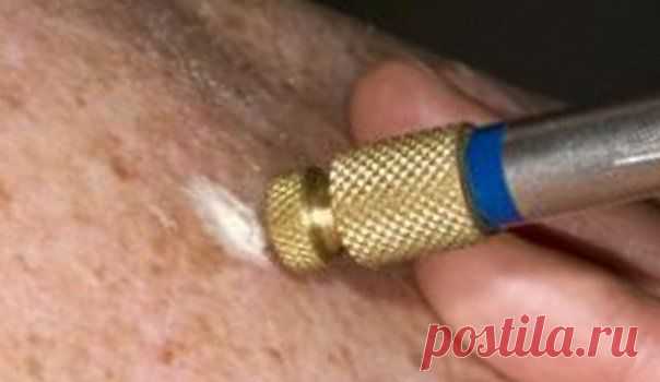 Методы удаления родинок: азотом, лазером, электрокоагуляцией, радионожом