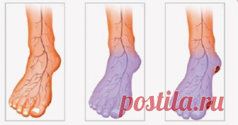 Важный момент вашего здоровья. 10 предупреждающих признаков плохого кровообращения 
 
Плохое кровообращение — это состояние, которое затрагивает многих людей во всем мире, и это может быть вызвано различными состояниями здоровья. На более поздних стадиях плохое кровообращение может …