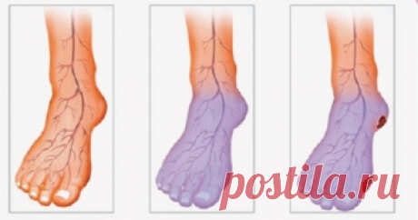 Важный момент вашего здоровья. 10 предупреждающих признаков плохого кровообращения 
 
Плохое кровообращение — это состояние, которое затрагивает многих людей во всем мире, и это может быть вызвано различными состояниями здоровья. На более поздних стадиях плохое кровообращение может …