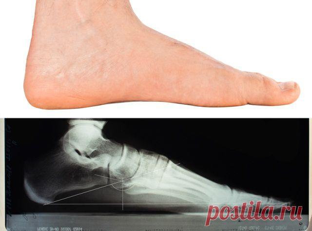 Плоскостопие у Взрослых – Симптомы и Лечение