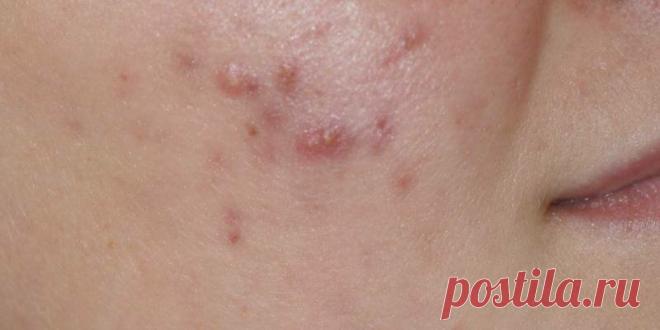 Грибок на лице: почему появляется, как лечить?
Мало кто знает, что грибок может быть не только на стопах, пальцах и ногтях. Он вполне вольготно чувствует себя и на лице человека. Почему же он там развивается? И можно ли избавиться от напасти? Как, вообще, узнать, что это именно грибок? Давайте во всем разбираться. Причины микоза лица Дерматомикозы лица вызываются, как правило, грибками-дерматофитами (рода […]
Читай дальше на сайте. Жми подробнее ➡