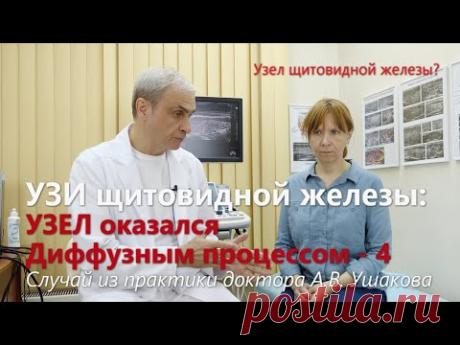 УЗИ щитовидной: Узел оказался Диффузным процессом! Пункция и Биопсия не нужны! /// Доктор Ушаков