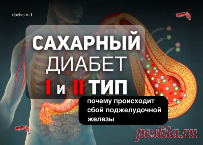 Сахарный диабет I и II тип: почему происходит сбой поджелудочной железы, группы риска, опасные симптомы, кому быть начеку?