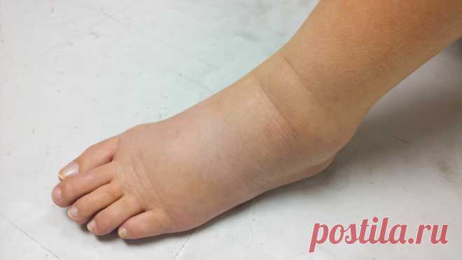 Лимфедема — не просто отек конечностей | Medical Note | Яндекс Дзен