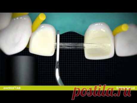 everStickC&amp;B fibre reinforced bridge for anterior region