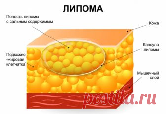 ЛИПОМА не образуется при здоровой печени