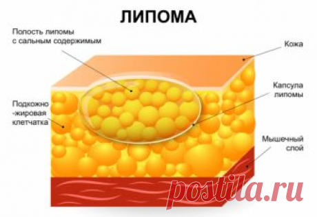 ЛИПОМА не образуется при здоровой печени