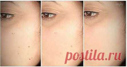 5 природных способов исцеления этих незыблемых темных пятен, известных как гиперпигментация!