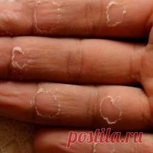 Сухость кожи. - МирТесен