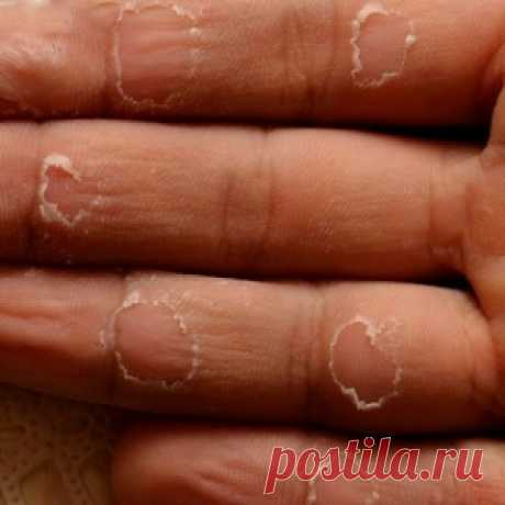 Сухость кожи. - МирТесен