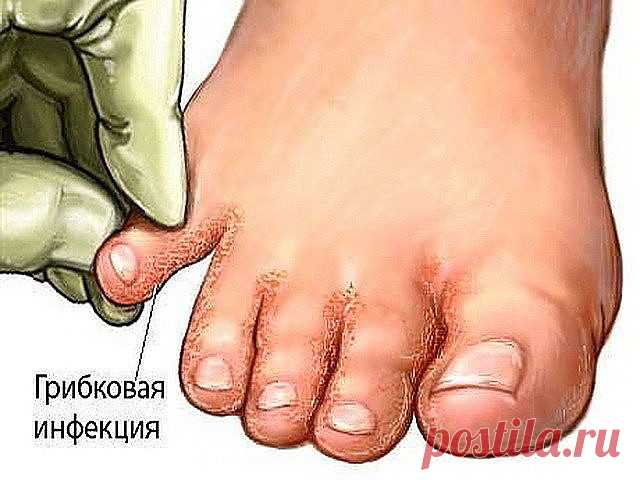 Многие не знают, что средства от грибка у них 