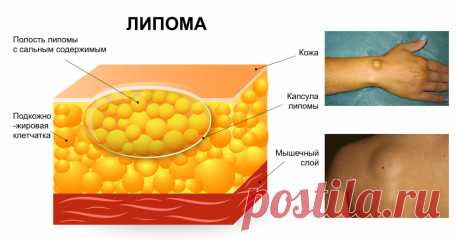 Избавься от липомы быстро и легко! 4 народных рецепта со 100% эффективностью. Смотри ВИДЕО Если липома появилась, сразу предпринимайте меры! Не затягивайте с визитом к врачу! Липома — это доброкачественная опухоль, которая состоит из жировой ткани. Она не доставляет особого дискомфорта, но может  увеличиваться в размерах. Бывают также случаи, что в липоме развивается патогенная флора, которая может привести к более серьёзным заболеваниям. Поэтому не стоит затягивать с визитом к врачу, как …