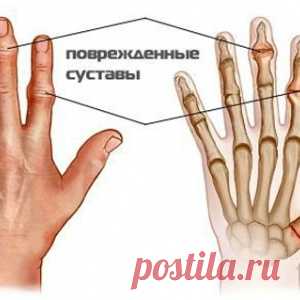 Как вылечить суставы пальцев рук: уникальный метод! - МирТесен