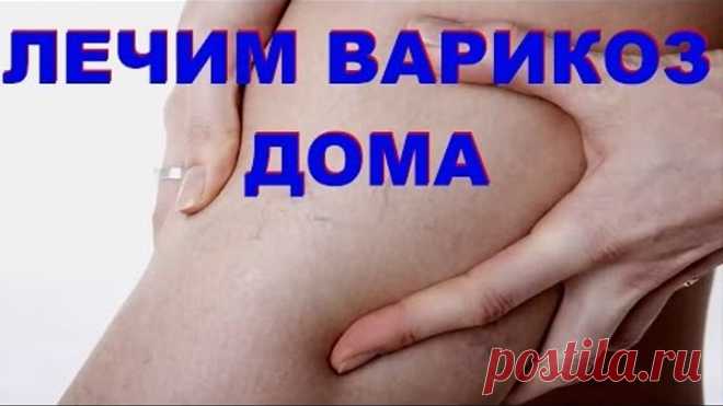 При варикозе