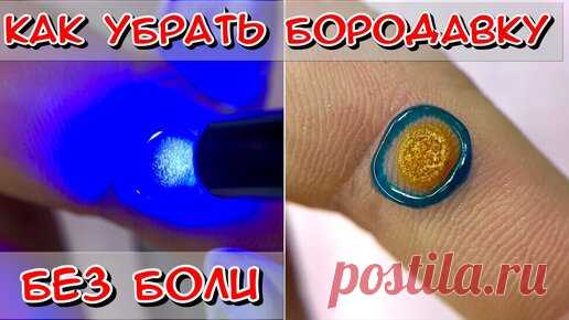 Алена Лаврентьева | Бородавка на пальце / Как выглядит бородавка? / Как лечить бородавку? / Что такое бородавка? ВПЧ