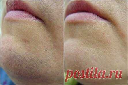 Убираем волосы не выходя из дома — навсегда!