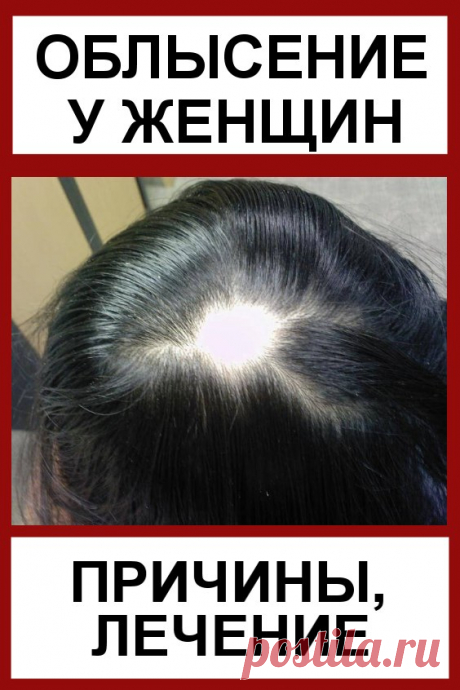Облысение у женщин: причины, лечение. Средства от облысения для женщин. Сегодня можно часто встретить женщин, которые страдают от выпадения волос. Причем у них появляются настоящие лысины. Естественно, они не очень приятны для дам, так как портят внешний вид прически и говорят о каких-либо проблемах со здоровьем. Если диагностируется облысение у женщин, причины (лечение часто зависит от них) определяют схему борьбы с заболеванием.