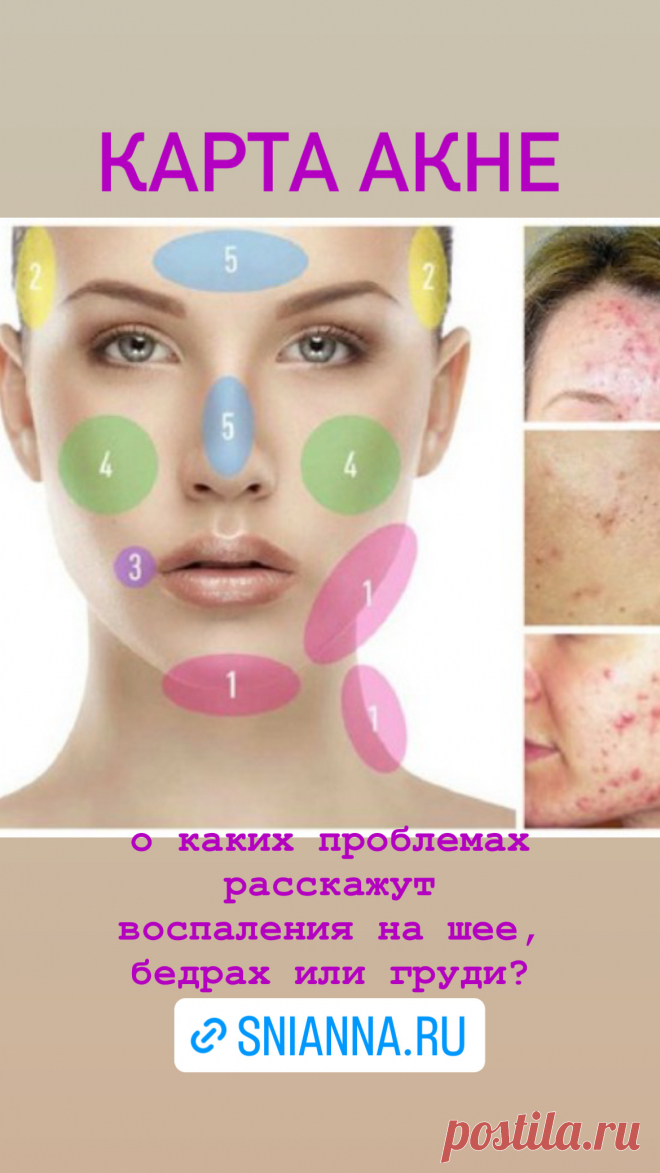 Карта акне: о каких проблемах расскажут воспаления на шее, бедрах или груди? Кликайте на фото, чтобы прочитать ⤴