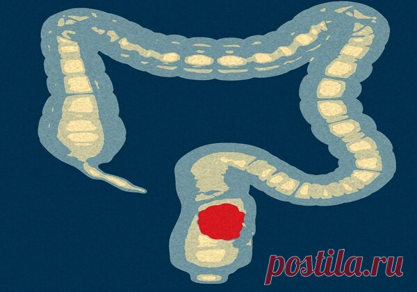 Первые признаки рака прямой кишки и его профилактика | Здравник | Яндекс Дзен