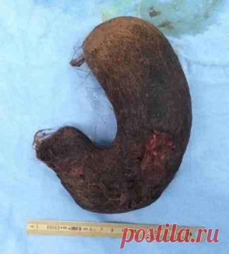 Каловый камень: причины, симптомы и лечение в статье проктолога Аколелова Е. С.