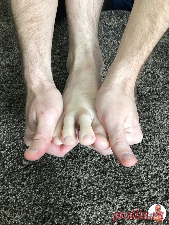 Соседка перестала прихрамывать. Оказалось, у нее было вальгусное искривление большого пальца ноги. Рассказываю, что ей помогло | НАЧФИЗ НА ПЕНСИИ | Яндекс Дзен