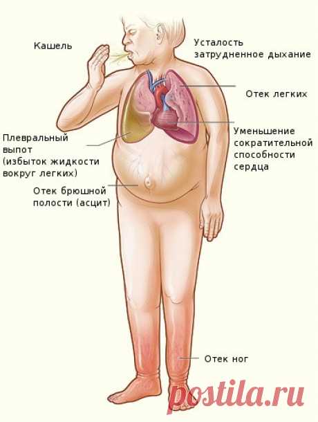Асцит брюшной полости: симптомы и лечение водянки живота