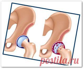 Коксартроз тазобедренного сустава - доктор Бубновкий (видеоурок)