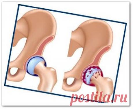 Коксартроз тазобедренного сустава - доктор Бубновкий (видеоурок)