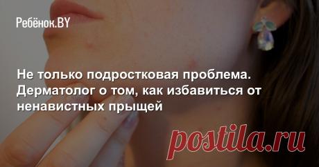 Не только подростковая проблема. Дерматолог о том, как избавиться от ненавистных прыщей Решать проблему нужно комплексно