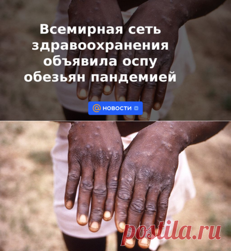 23-6-22-Всемирная сеть здравоохранения объявила оспу обезьян пандемией - Новости Mail.ru