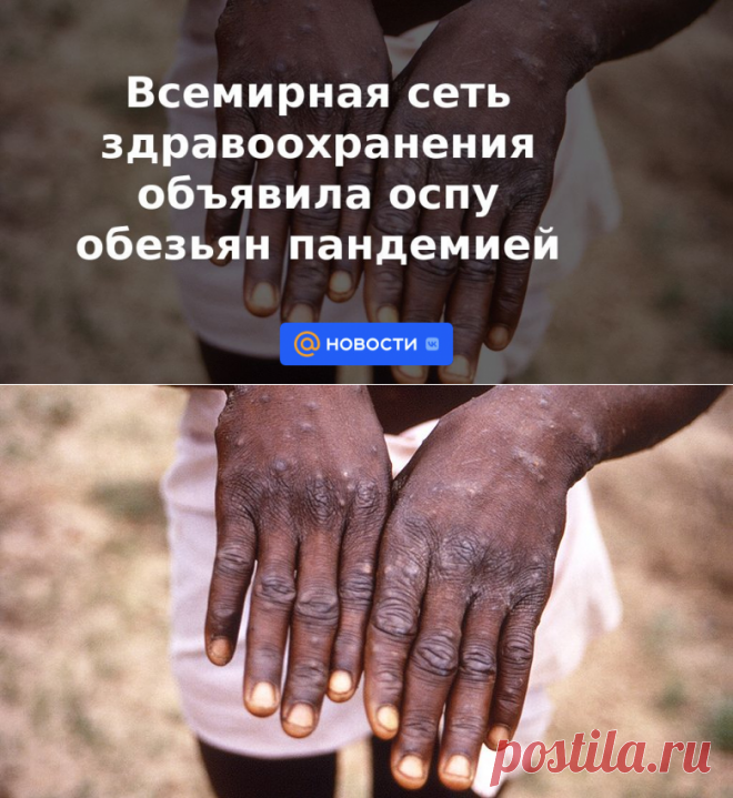 23-6-22-Всемирная сеть здравоохранения объявила оспу обезьян пандемией - Новости Mail.ru