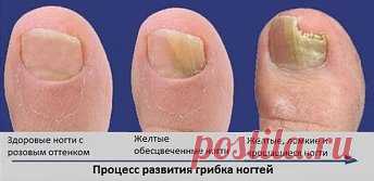 Многие не знают, что средства от грибка у них 