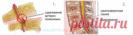 Экстравазальная компрессия и стеноз позвоночных артерий: лечение, признаки, причины