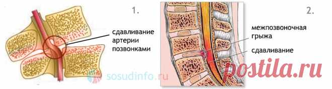 Экстравазальная компрессия и стеноз позвоночных артерий: лечение, признаки, причины