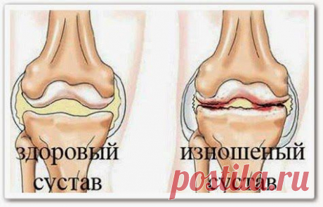 Артроз коленных суставов (видео урок)