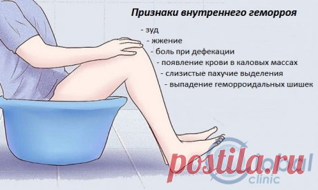 Признаки внутреннего геморроя: что важно знать простому обывателю | ЦМ «Глобал клиник» - услуги в области проктологии, урологии, гинекологии, УЗИ и лабораторной диагностики в Нижнем Новгороде