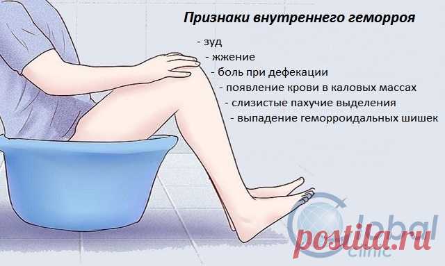 Признаки внутреннего геморроя: что важно знать простому обывателю | ЦМ «Глобал клиник» - услуги в области проктологии, урологии, гинекологии, УЗИ и лабораторной диагностики в Нижнем Новгороде