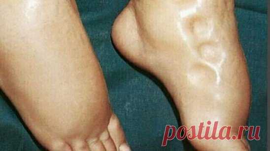 КАК ИЗБАВИТЬСЯ ОТ ОТЕКОВ И ПРИВЕСТИ ДАВЛЕНИЕ В НОРМУ.
Покупаем в магазине хлопья геркулеса. При покупке этого продукта есть один ньюанс: обязательно смотрите чтобы на дне упаковки стояла цифра 1. Это означает, что эти хлопья самые крупные, и стараемся чтобы срок годности не превышал 6 месяцев — так полезнее.
На одну порцию берем 2 ст ложки хлопьев с верхом, промываем через дуршлаг в проточной воде, заливаем 300 мл крутого кипятка, кипятим пять минут и настаиваем десять мин...