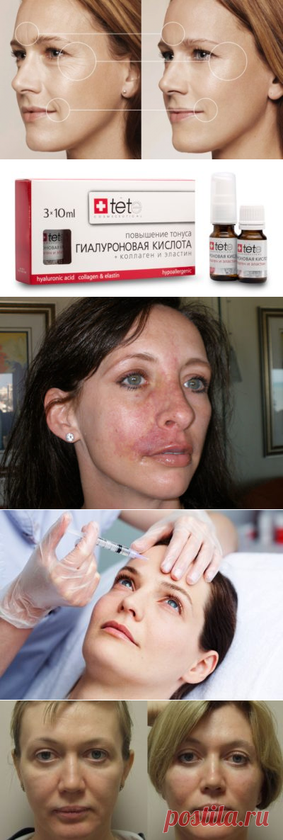 Уколы гиалуроновой кислоты, отзывы, фото до и после, цена