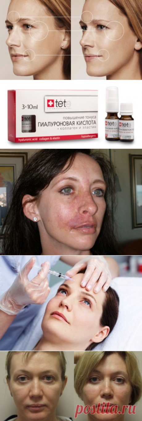 Уколы гиалуроновой кислоты, отзывы, фото до и после, цена